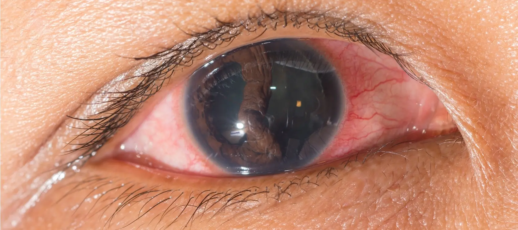 Desprendimiento de retina